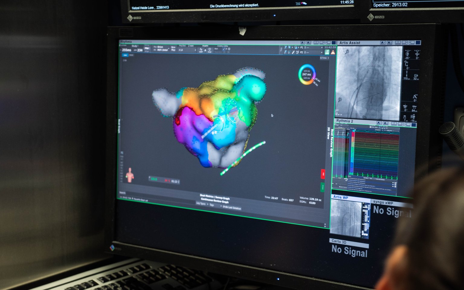 3D-Mapping kommt an der Uniklinik Essen zum Einsatz, um Störungen am Herzen ohne viel belastenden Aufwand zu therapieren.
