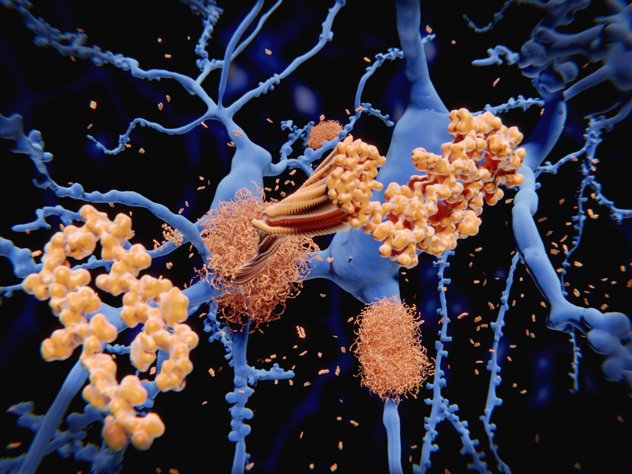 Amyloid-Protein bei einer Alzheimer-Erkrankung.