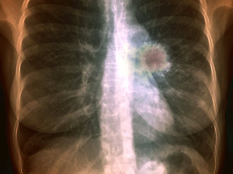 MRT Lungentumor