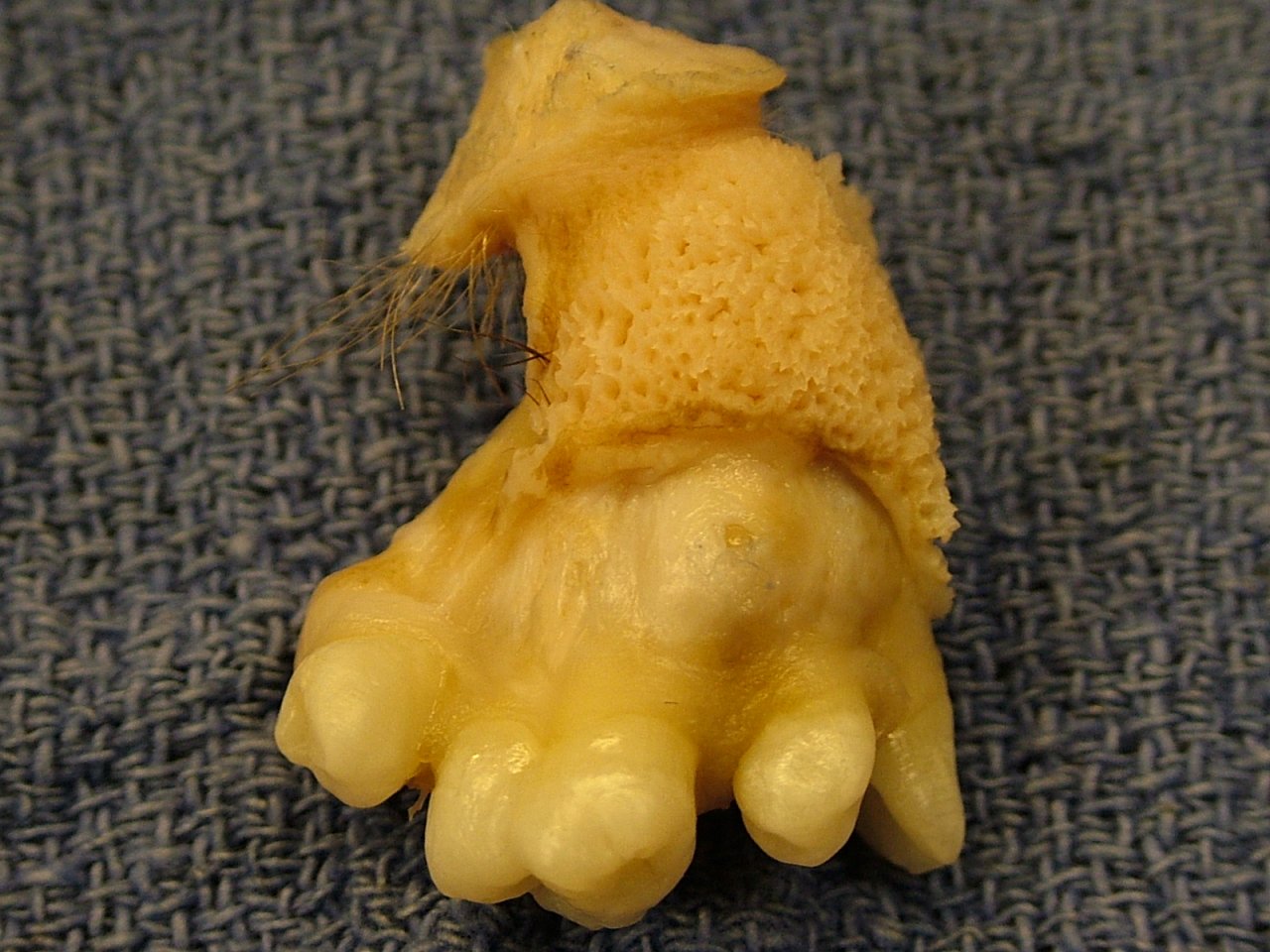 Gewebe mit Zähnen, Haut und Haaren aus einem Teratom des Eierstocks