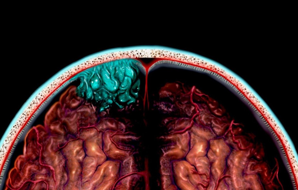 Hirntumor