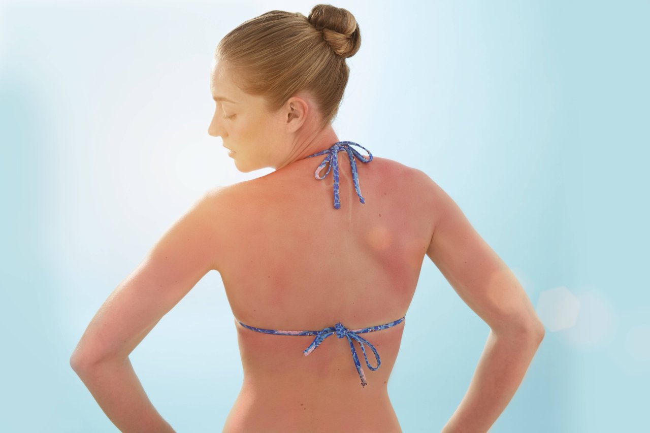 Sonnenbrände sind ein Gesundheitsrisiko. Mit diesen Apps vermeidest du, dass deine Haut leidet. 