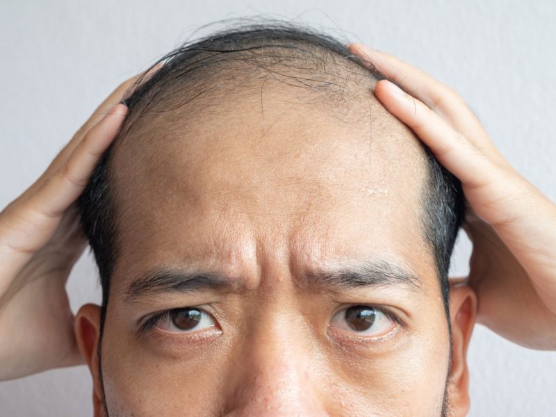 Mann mit Haarausfall zeigt seinen Kopf.