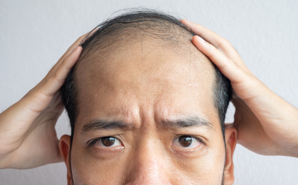 Mann mit Haarausfall zeigt seinen Kopf.